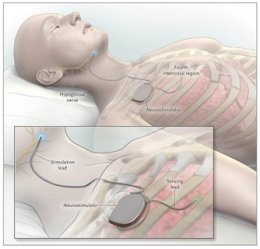 บอกเลิก CPAP ด้วย "เครื่องกระตุ้นทางเดินหายใจ UAS"